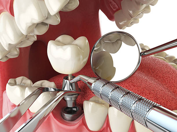 Best Emergency Tooth Extraction in Pleasant View, TN